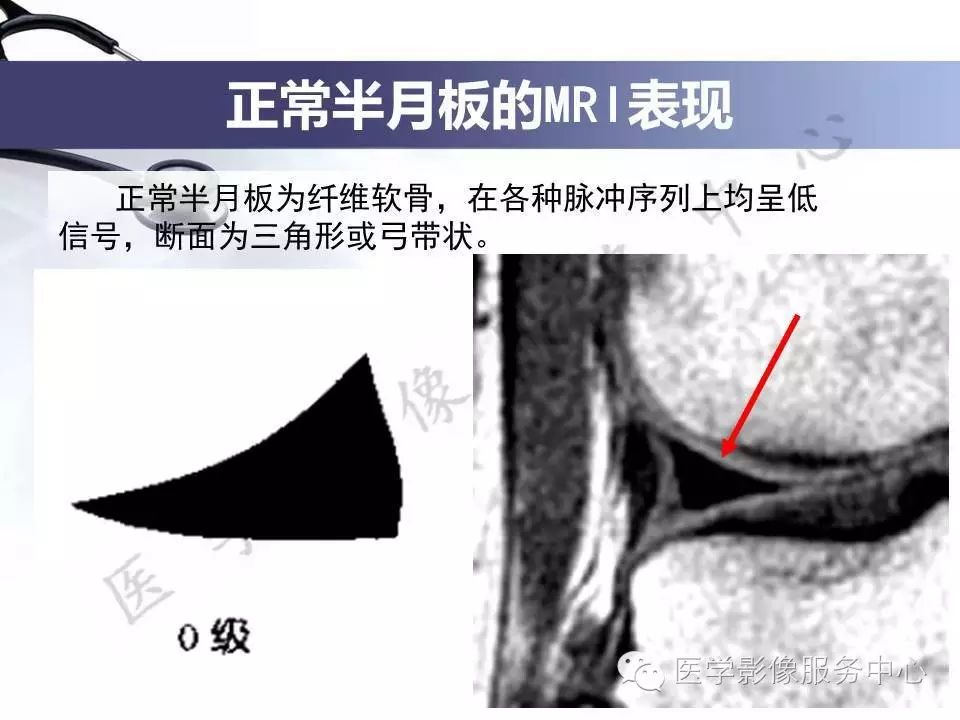 半月板病变的磁共振诊断，值得一看！