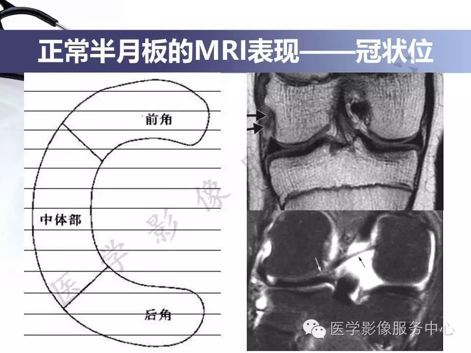 半月板病变的磁共振诊断，值得一看！