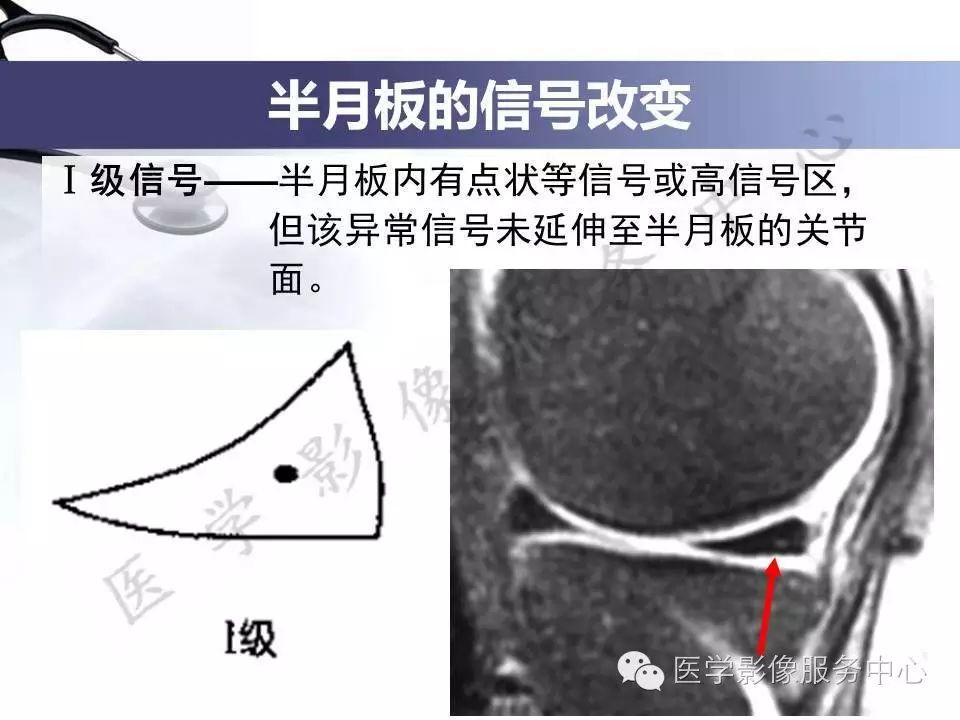 半月板病变的磁共振诊断，值得一看！