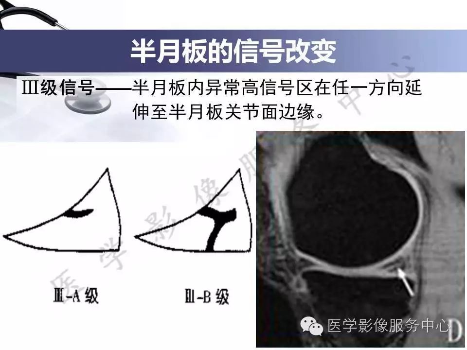 半月板病变的磁共振诊断，值得一看！