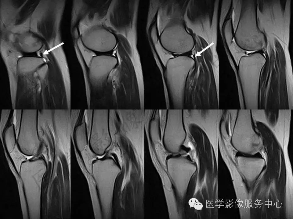 半月板病变的磁共振诊断，值得一看！