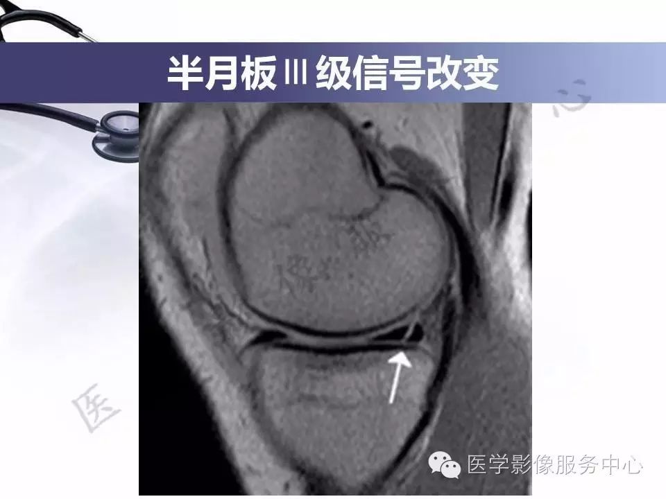 半月板病变的磁共振诊断，值得一看！