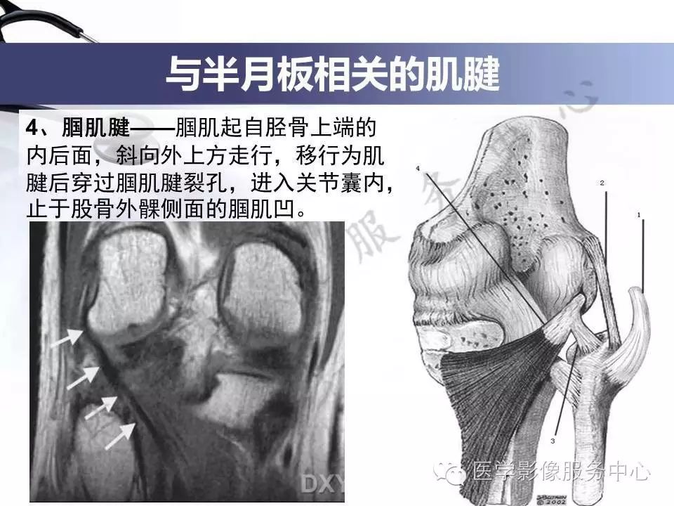 半月板病变的磁共振诊断，值得一看！