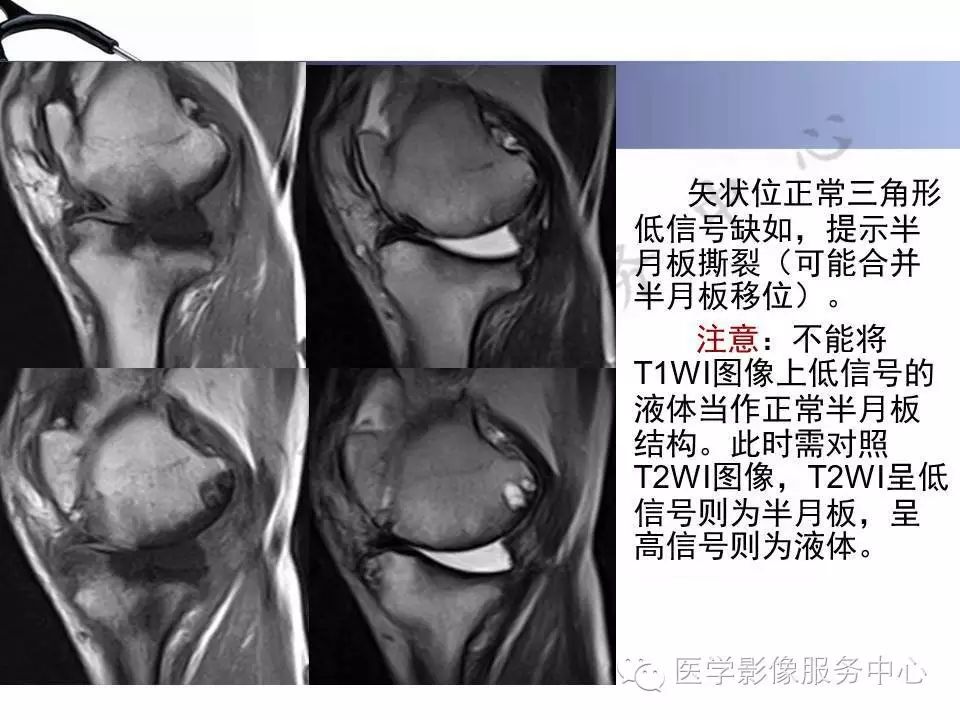 半月板病变的磁共振诊断，值得一看！