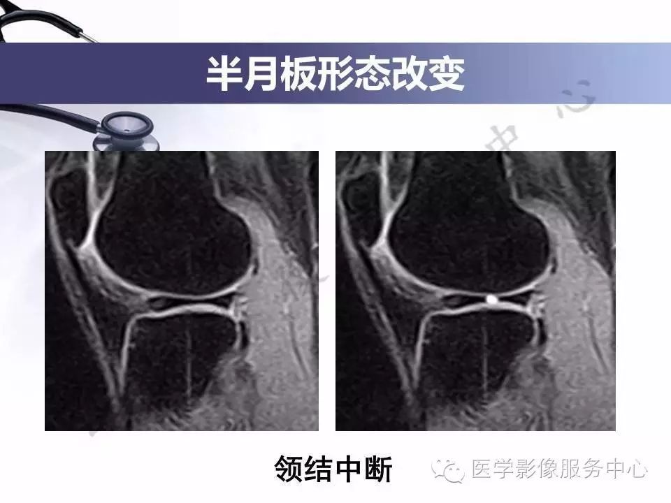 半月板病变的磁共振诊断，值得一看！