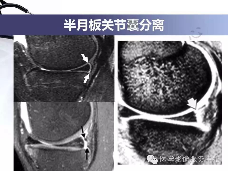 半月板病变的磁共振诊断，值得一看！