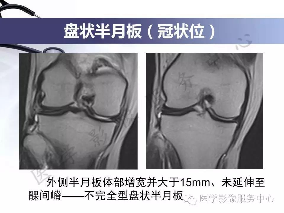 半月板病变的磁共振诊断，值得一看！