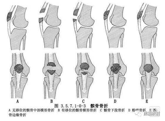 下肢骨折分型大全（内含示意图）