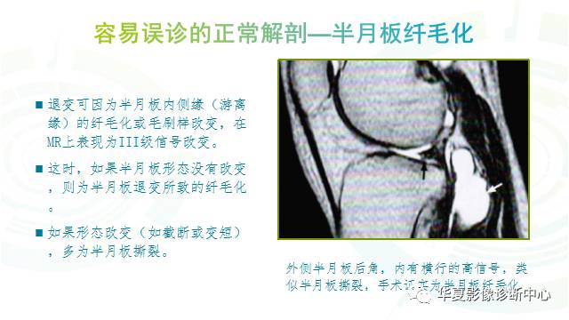 那些易误诊为半月板损伤的细节您都认识吗？