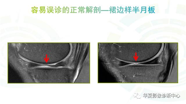 那些易误诊为半月板损伤的细节您都认识吗？