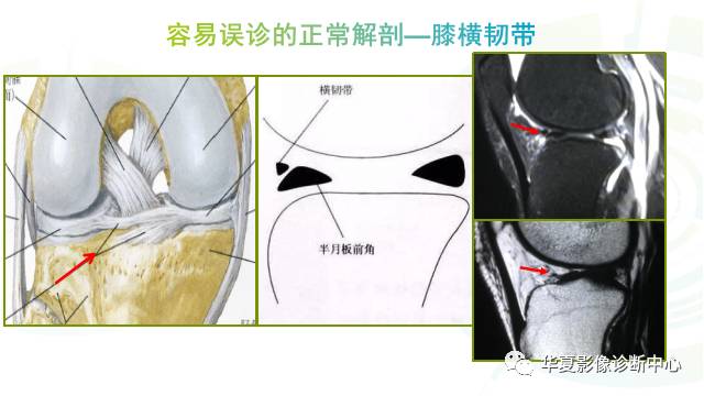 那些易误诊为半月板损伤的细节您都认识吗？