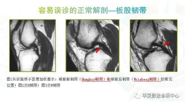 那些易误诊为半月板损伤的细节您都认识吗？