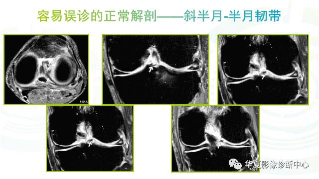 那些易误诊为半月板损伤的细节您都认识吗？