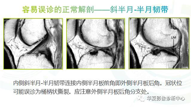 那些易误诊为半月板损伤的细节您都认识吗？