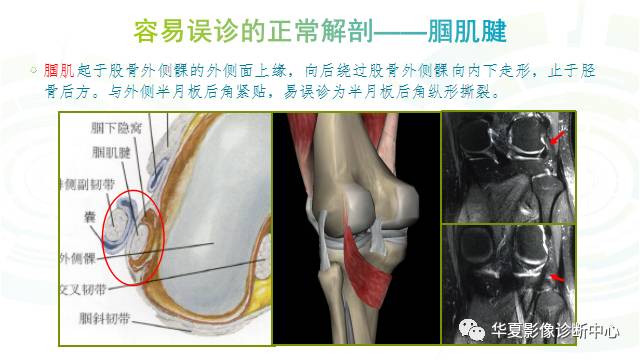 那些易误诊为半月板损伤的细节您都认识吗？