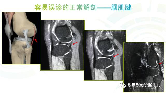 那些易误诊为半月板损伤的细节您都认识吗？