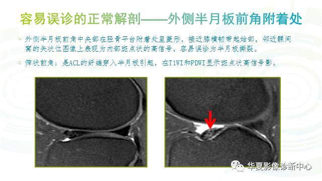 那些易误诊为半月板损伤的细节您都认识吗？