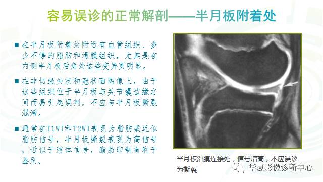 那些易误诊为半月板损伤的细节您都认识吗？