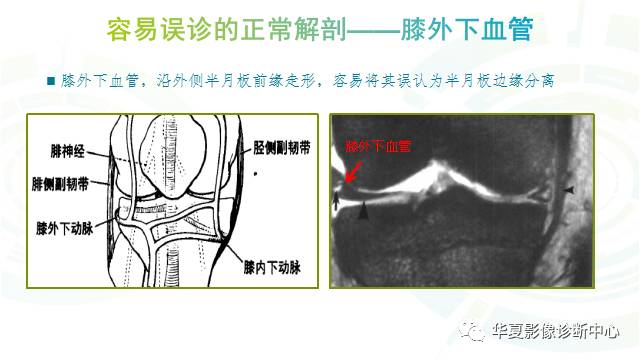 那些易误诊为半月板损伤的细节您都认识吗？