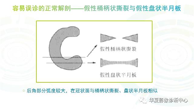 那些易误诊为半月板损伤的细节您都认识吗？