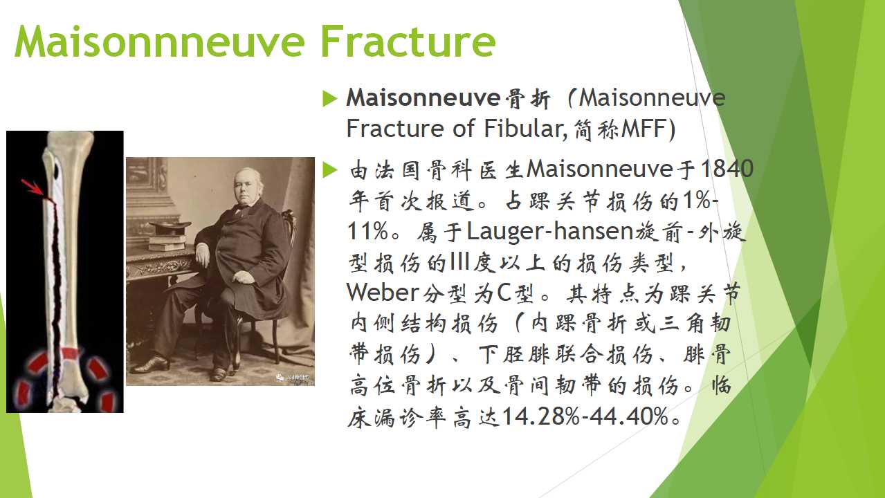 特殊类型的踝关节骨折（一）：Maisonneuve