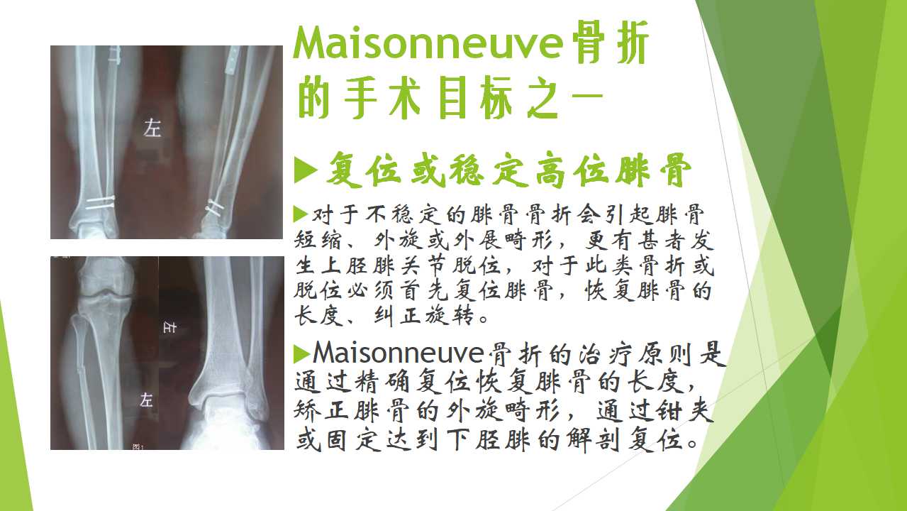 特殊类型的踝关节骨折（一）：Maisonneuve