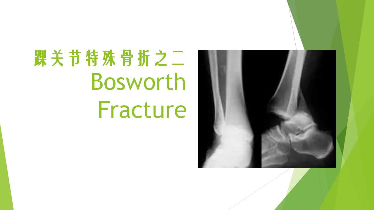 特殊类型的踝关节骨折（二）：Bosworth