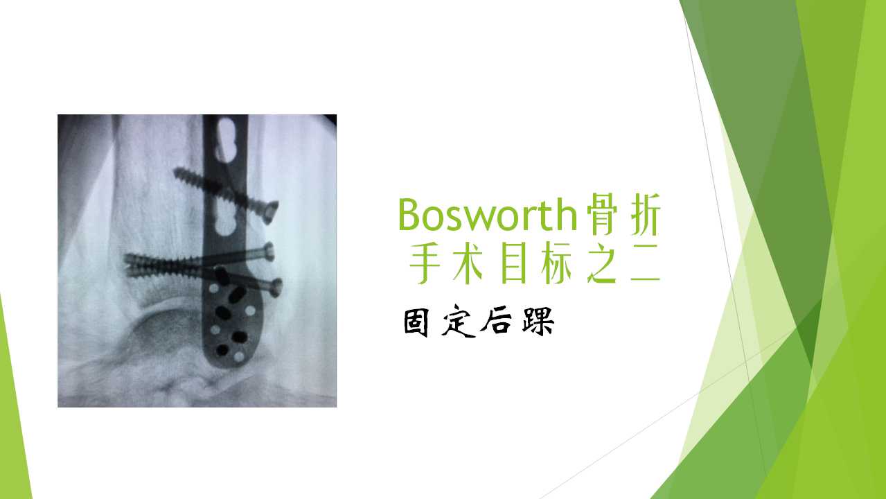 特殊类型的踝关节骨折（二）：Bosworth