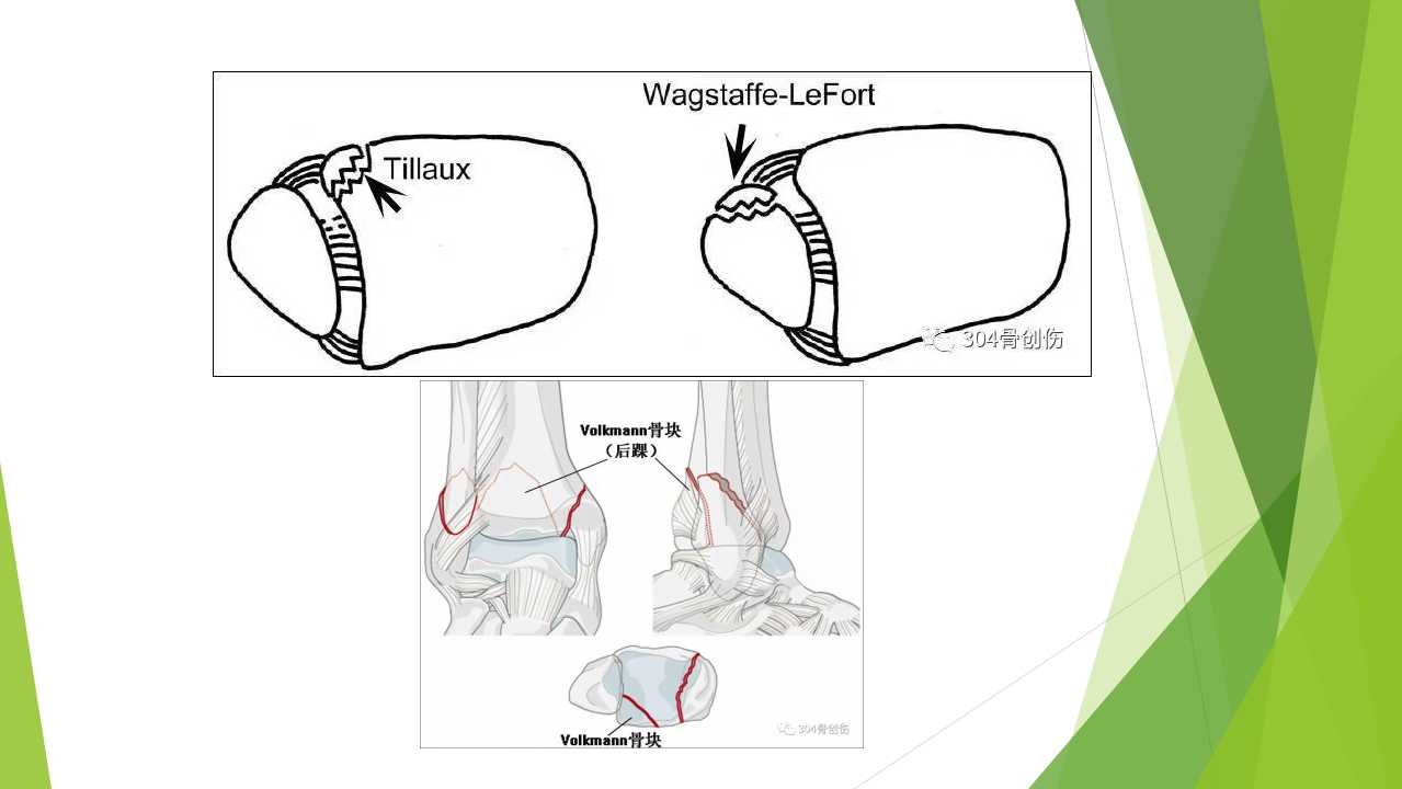 特殊类型的踝关节骨折（三）：LogsplitterFracture