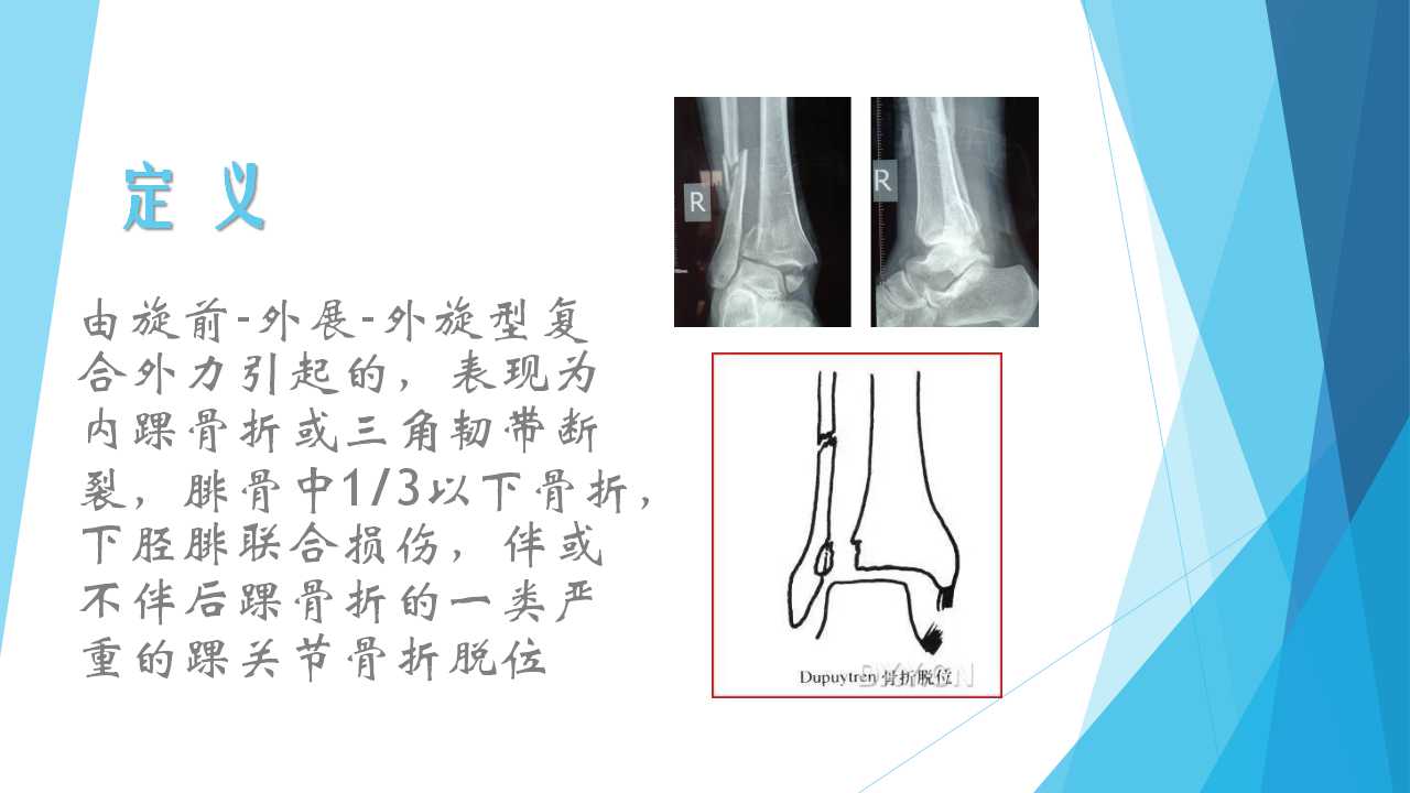 特殊类型的踝关节骨折（四）：Dupuytren