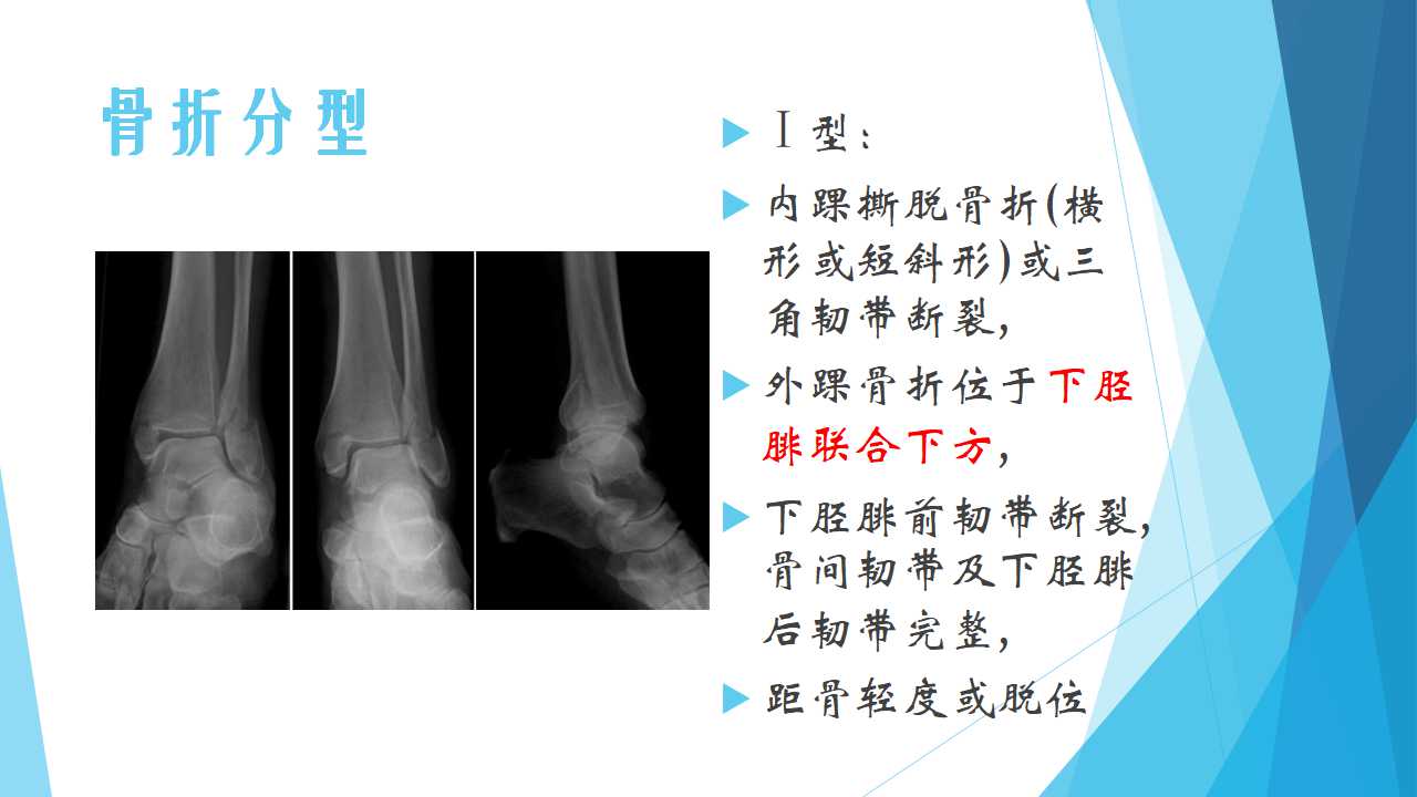 特殊类型的踝关节骨折（四）：Dupuytren