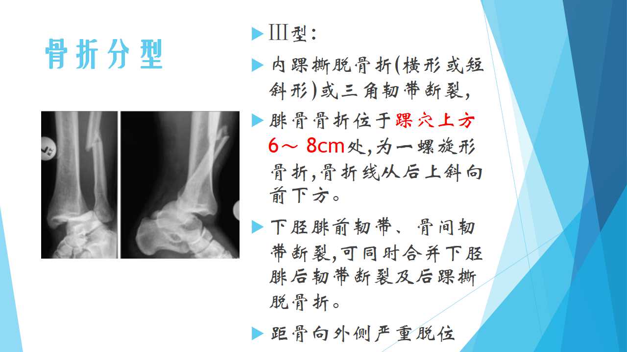 特殊类型的踝关节骨折（四）：Dupuytren