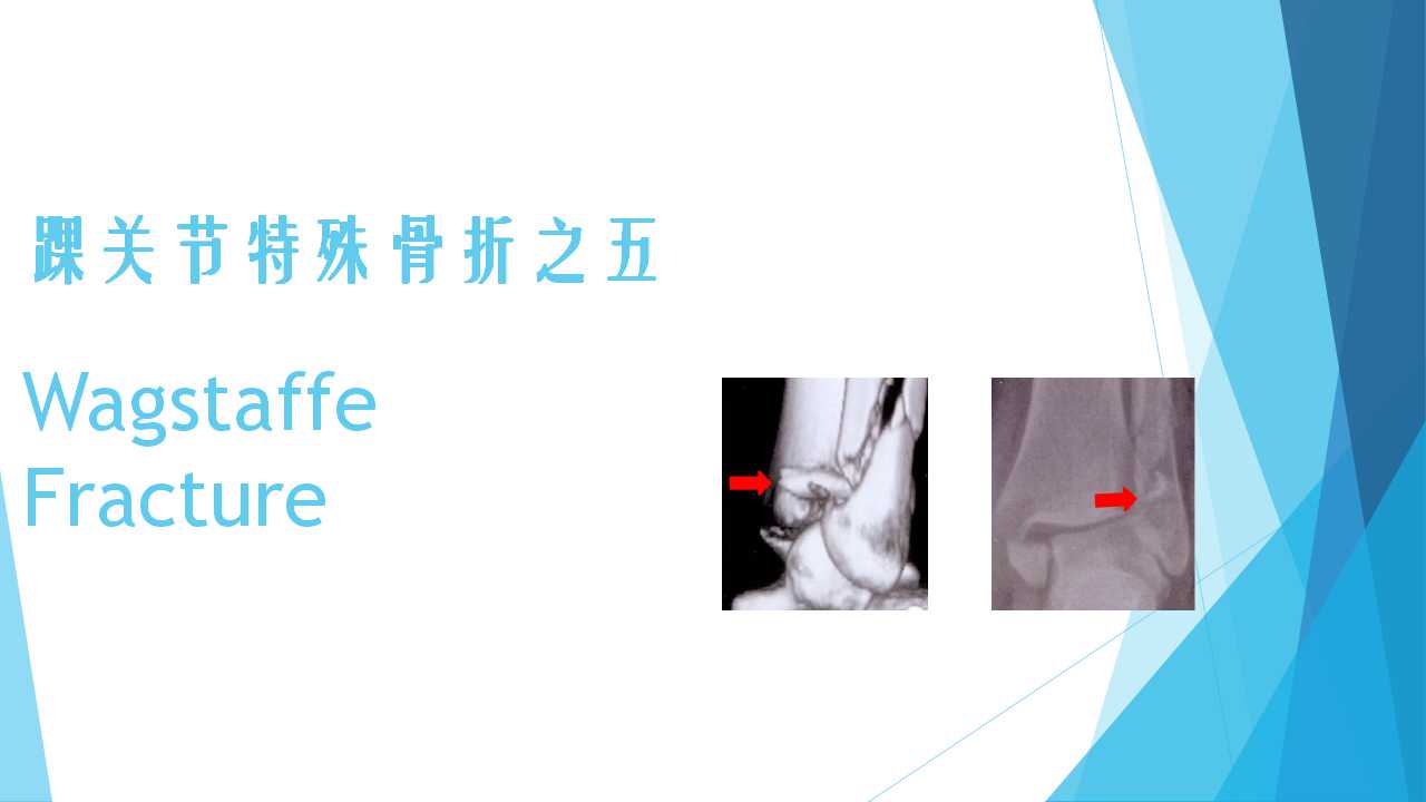 特殊类型的踝关节骨折（五）：Wagstaffe