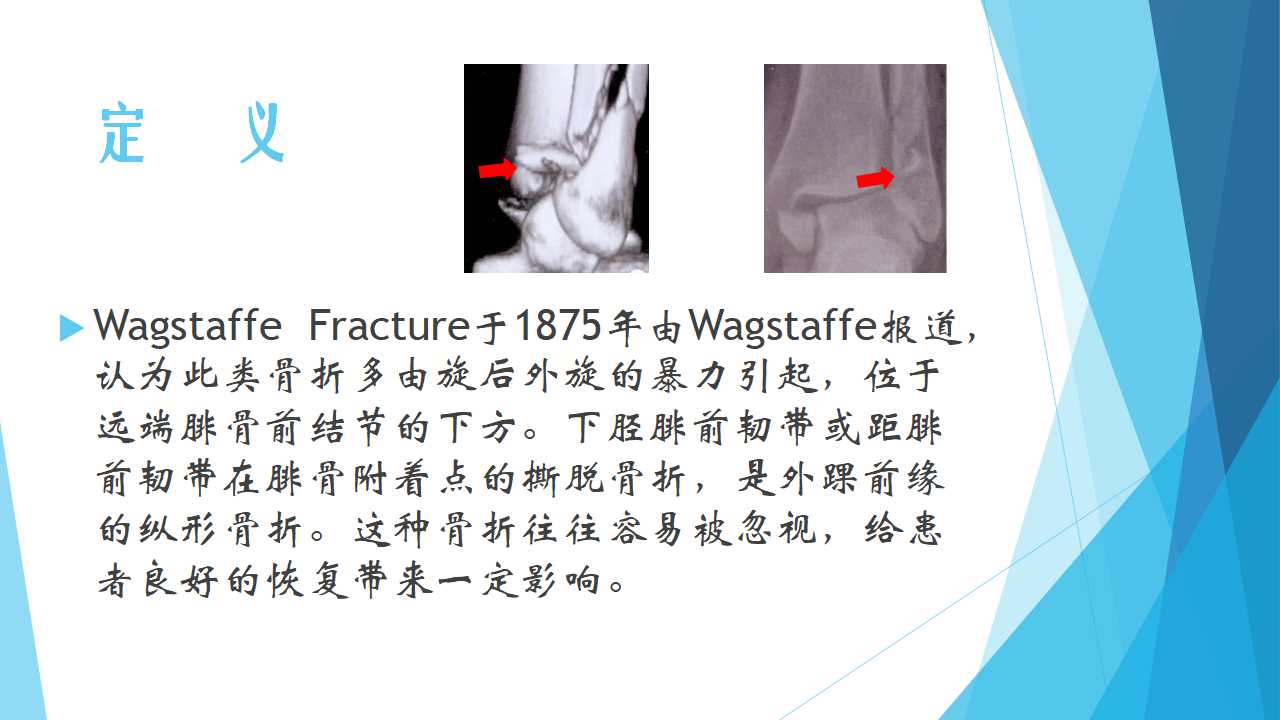 特殊类型的踝关节骨折（五）：Wagstaffe