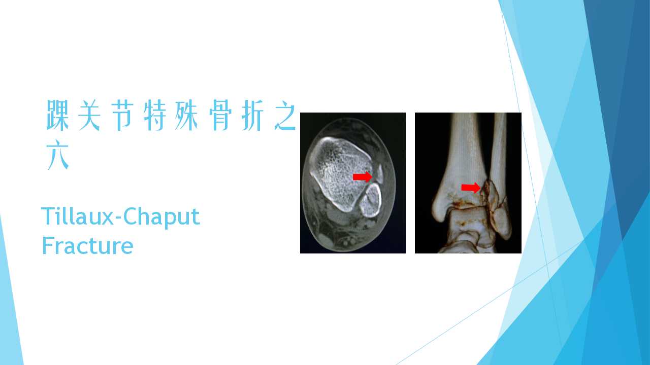 特殊类型的踝关节骨折（六）：Tillaux-Chaput Fracture - 好医术早读 