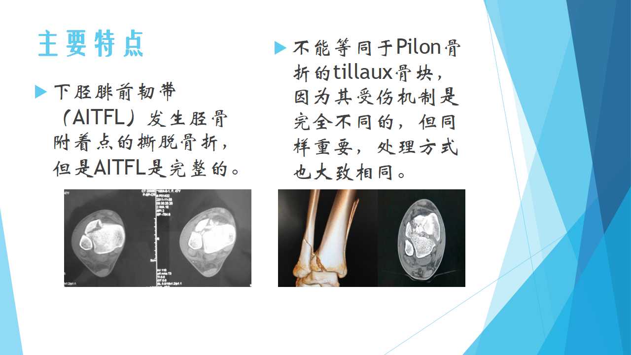 特殊类型的踝关节骨折（六）：Tillaux-Chaput