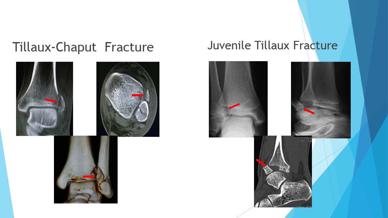 特殊类型的踝关节骨折（六）：Tillaux-Chaput