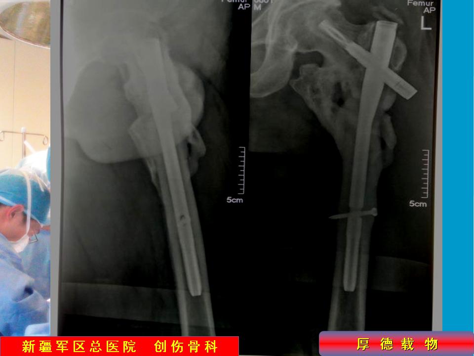 粗隆间骨折髓内钉的置钉技巧与细节