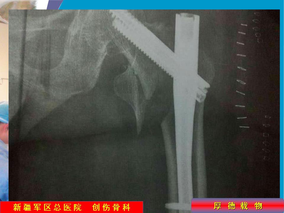 粗隆间骨折髓内钉的置钉技巧与细节