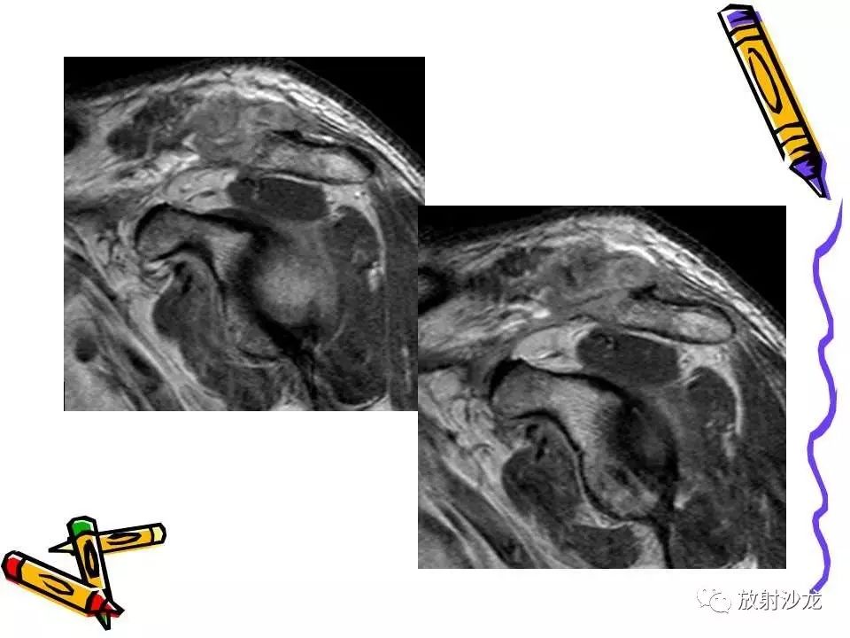 肩关节常见创伤性病变的影像表现