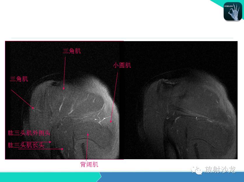 肩关节常见疾病的MRI表现