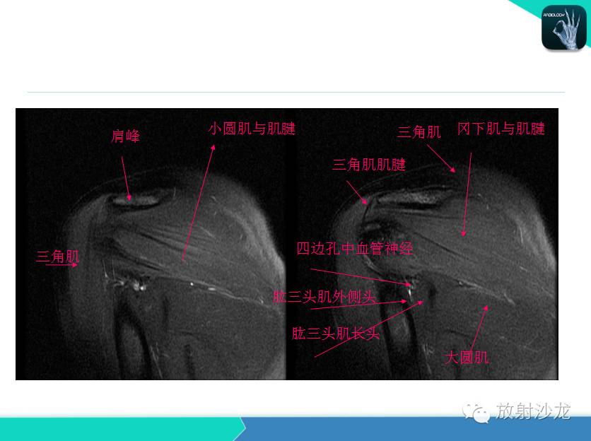 肩关节常见疾病的MRI表现