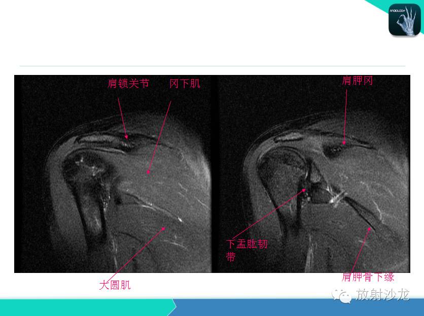 肩关节常见疾病的MRI表现