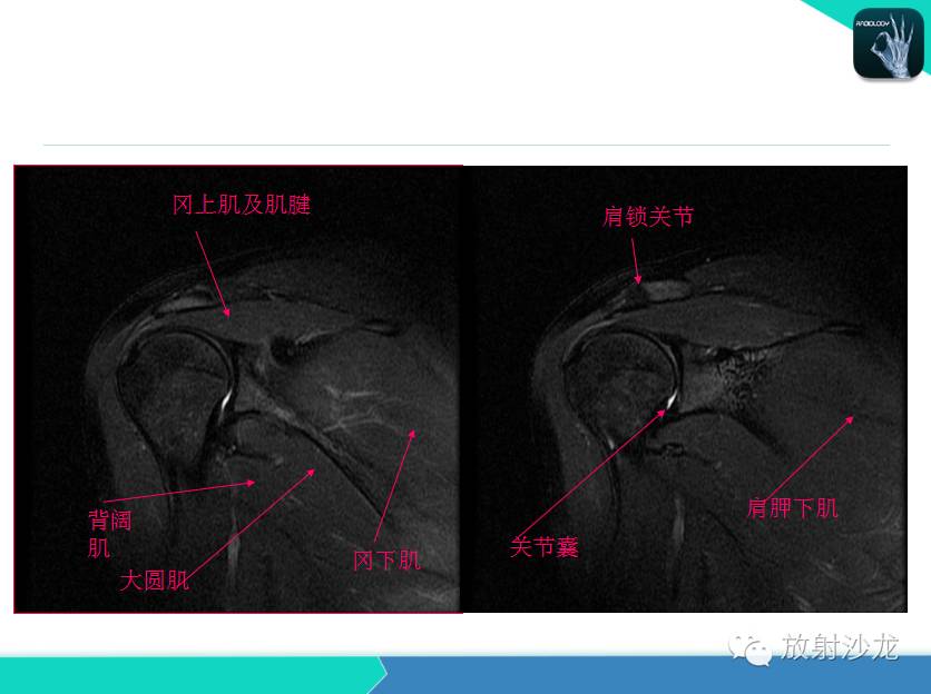 肩关节常见疾病的MRI表现