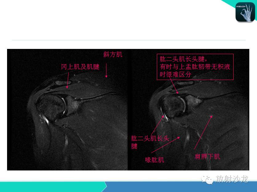 肩关节常见疾病的MRI表现