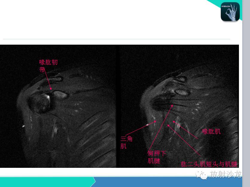 肩关节常见疾病的MRI表现