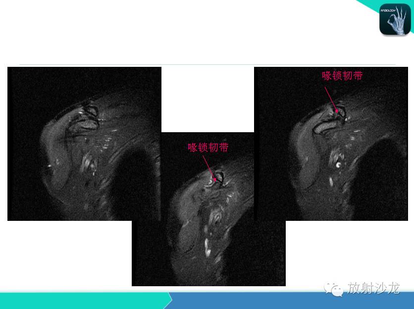 肩关节常见疾病的MRI表现
