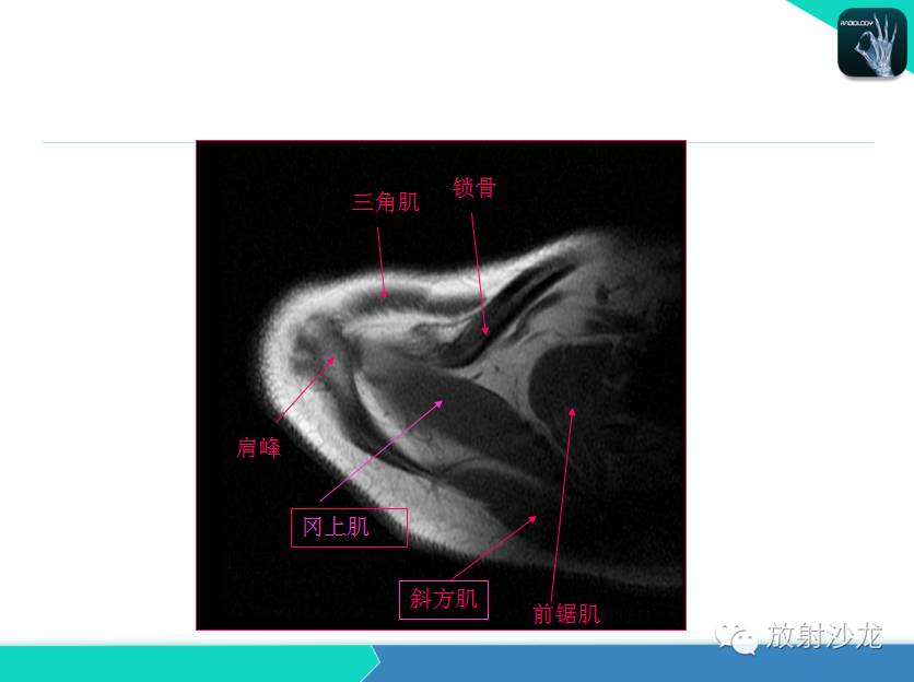 肩关节常见疾病的MRI表现