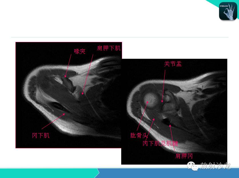 肩关节常见疾病的MRI表现