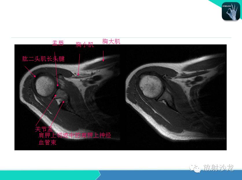 肩关节常见疾病的MRI表现